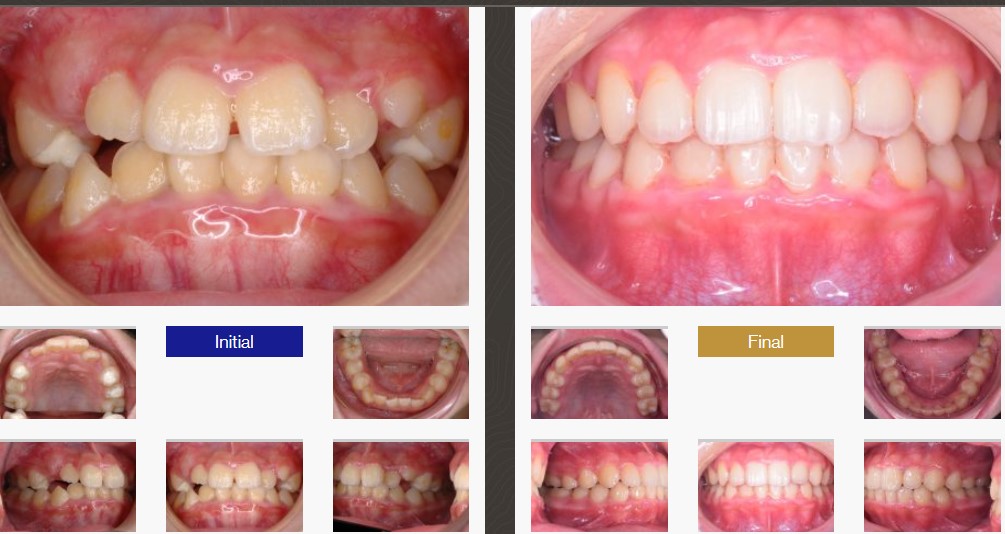 Invisalign vs Braces – Langley Family Dentistry